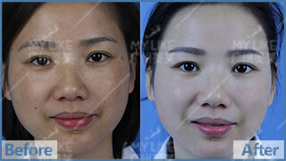 雙皮秒祛綜合斑前后對比