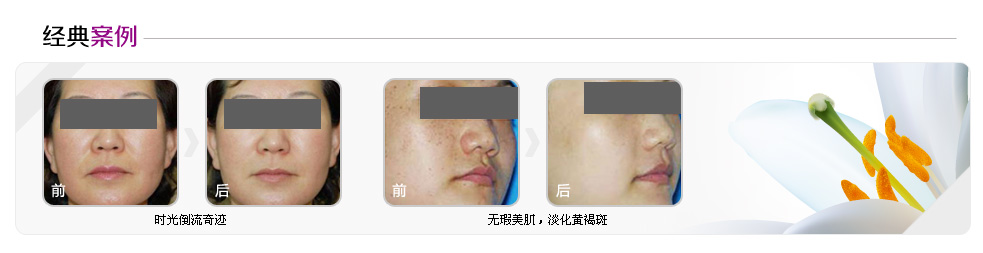 美萊胎盤多肽抗衰老案例