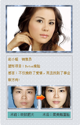 美萊微整非手術(shù)塑形真實案例——BOTOX瘦臉