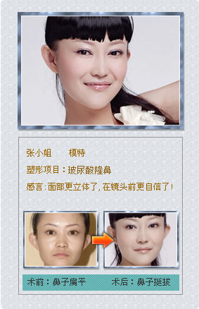 美萊微整非手術(shù)塑形真實案例——愛貝芙隆鼻