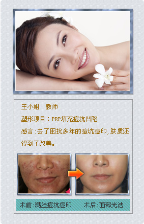 美萊微整非手術(shù)塑形真實案例——PRP填充痘坑凹陷